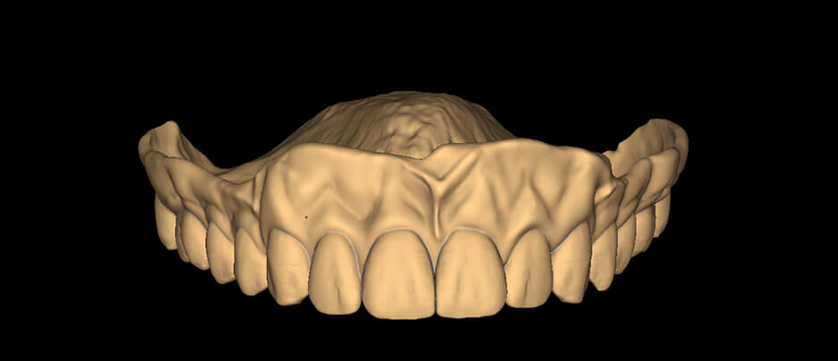 Monolithic Denture- Round - Hypernatural