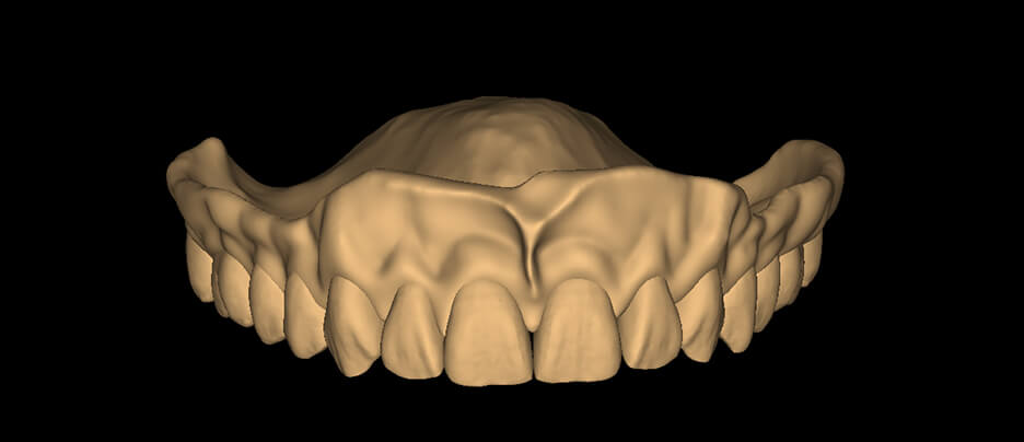 Monolithic Denture - Sqaure Tapered - HyperNatural