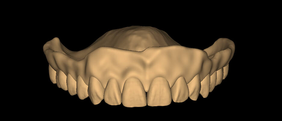 Monolithic Denture - Sqaure Tapered - Natural