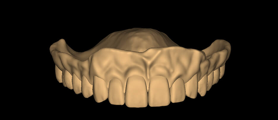 Monolithic Denture - Square - HyperNatural