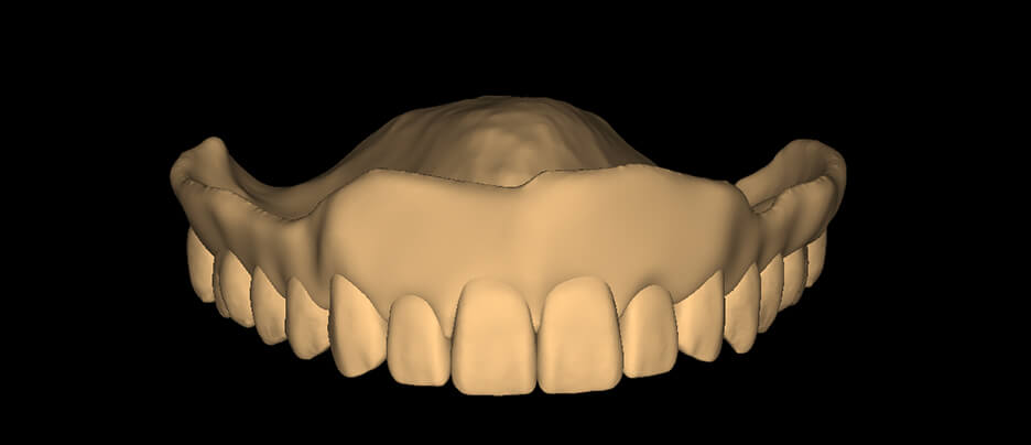 Monolithic Denture - Square - Smooth