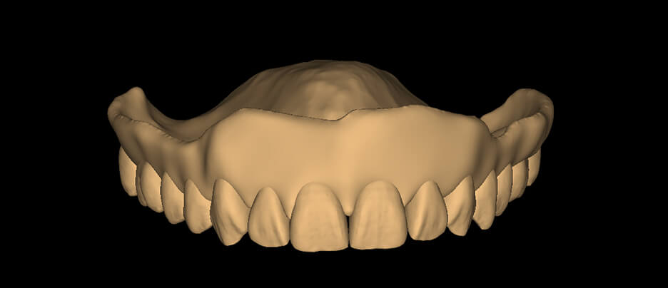 Monolithic Denture - Square Tapered - Smooth