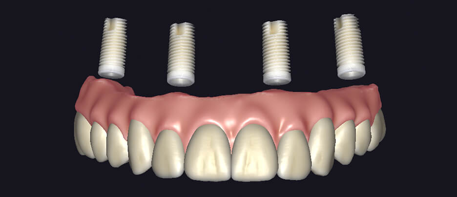 All on X Tooth Library Selection