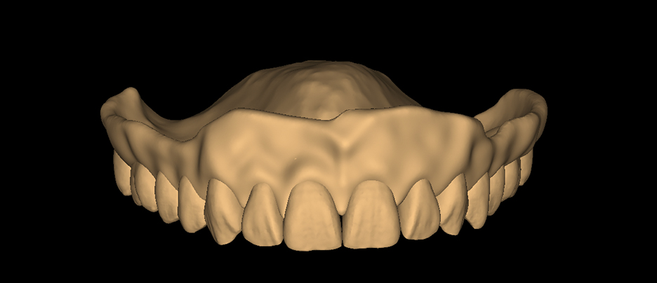 Monolithic Denture - Sqaure Tapered - Natural
