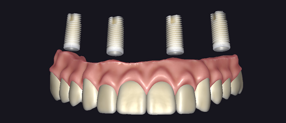 new-all-on-x-square-natural